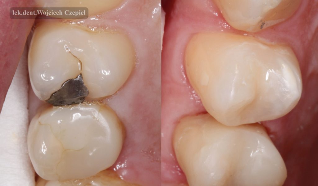 Górna 4 i 5 przed i po leczeniu