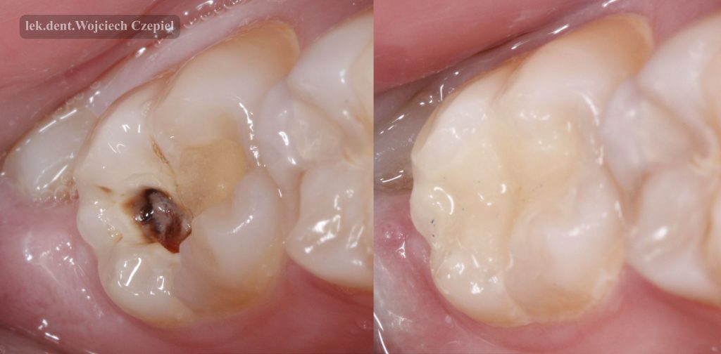Dolna "7" z próchnicą oraz po leczeniu