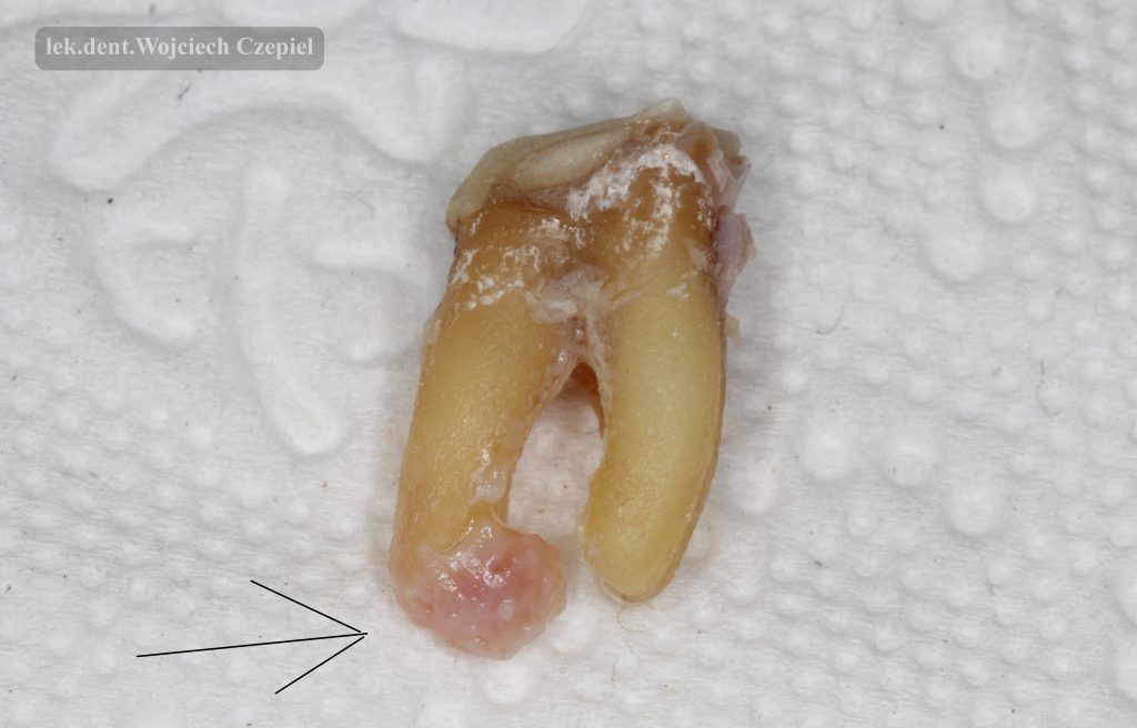 Torbiel korzeniowa - tak wygląda ząb nie leczony kanałowo. W środku jest ropa.