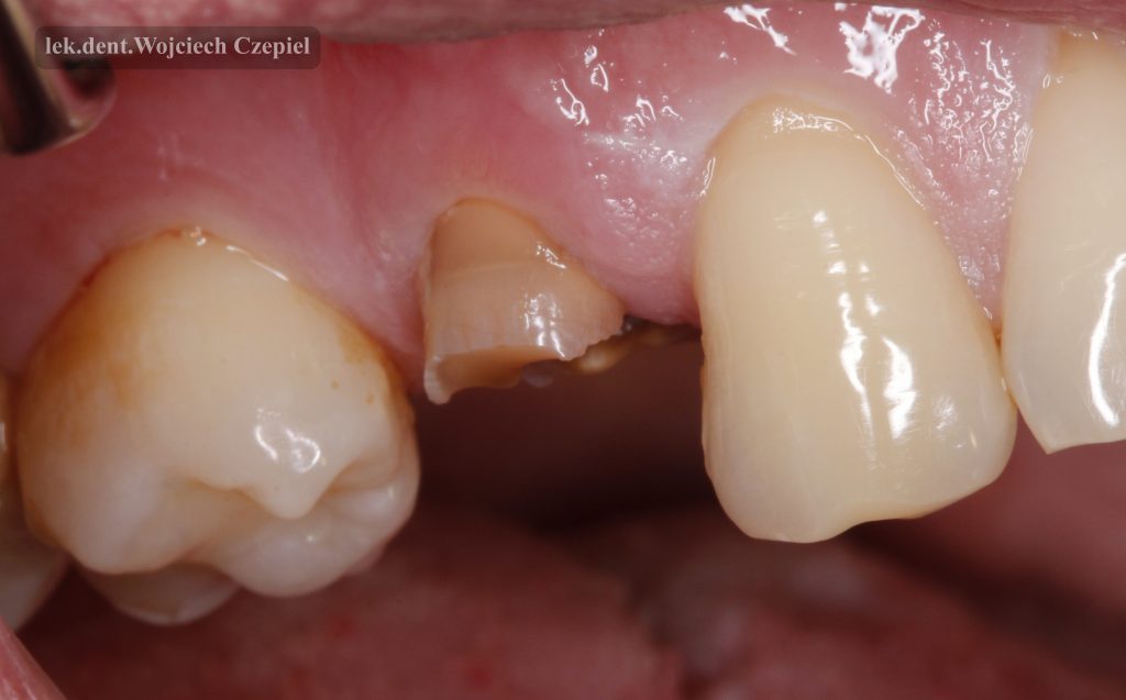 Złamana korona zęba - pacjent ma braki zębowe z drugiej strony - przeciąża pozostałe zęby